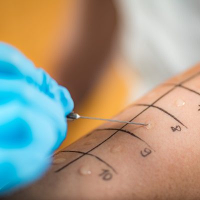 Immunologist Doing Skin Prick Allergy Test on a Woman’s Arm